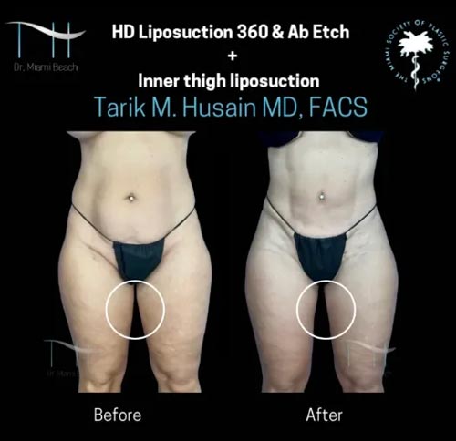 Liposuction Gallery at Dr. Miami Beach in Miami Beach, FL