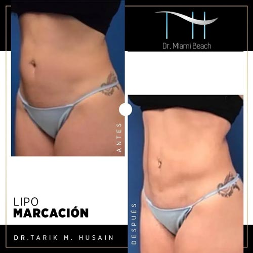 Liposuction Gallery at Dr. Miami Beach in Miami Beach, FL