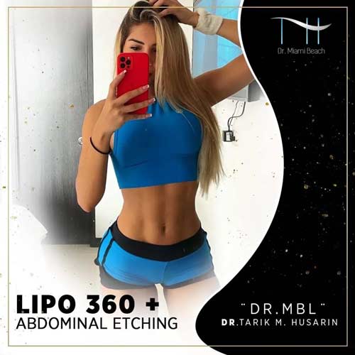 Liposuction Gallery at Dr. Miami Beach in Miami Beach, FL