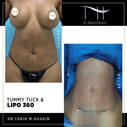 Liposuction Gallery at Dr. Miami Beach in Miami Beach, FL