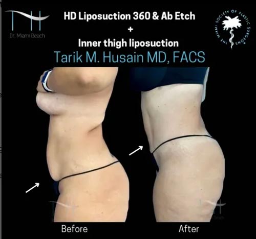 Liposuction Gallery at Dr. Miami Beach in Miami Beach, FL