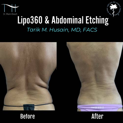Liposuction Gallery at Dr. Miami Beach in Miami Beach, FL