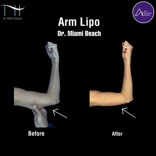 Liposuction Gallery at Dr. Miami Beach in Miami Beach, FL