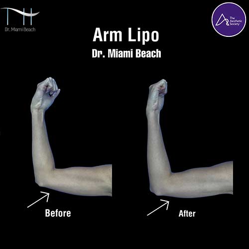 Liposuction Gallery at Dr. Miami Beach in Miami Beach, FL