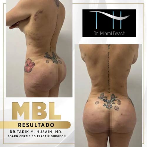 Miami Butt Lift Gallery at Dr. Miami Beach in Miami Beach, FL