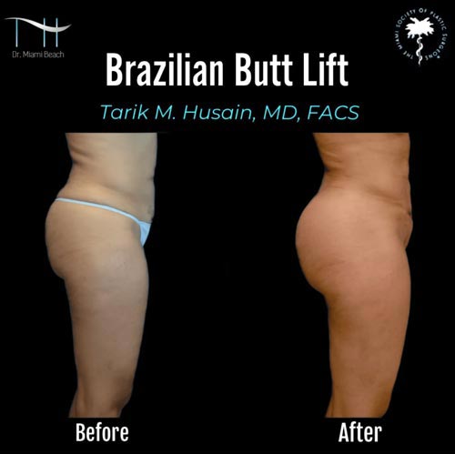 Miami Butt Lift Gallery at Dr. Miami Beach in Miami Beach, FL