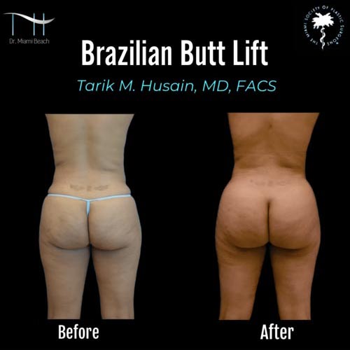 Miami Butt Lift Gallery at Dr. Miami Beach in Miami Beach, FL