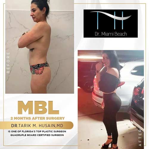 Miami Butt Lift Gallery at Dr. Miami Beach in Miami Beach, FL