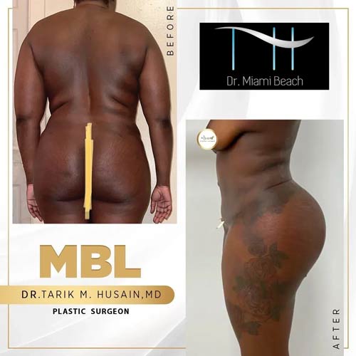 Miami Butt Lift Gallery at Dr. Miami Beach in Miami Beach, FL