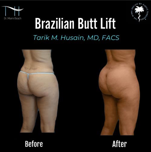 Miami Butt Lift Gallery at Dr. Miami Beach in Miami Beach, FL
