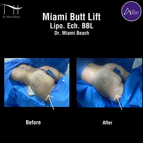 Miami Butt Lift Gallery at Dr. Miami Beach in Miami Beach, FL