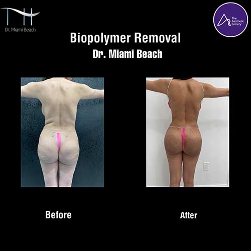 Miami Butt Lift Gallery at Dr. Miami Beach in Miami Beach, FL