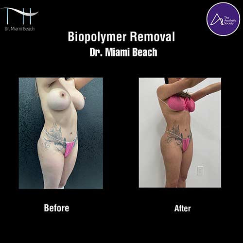 Miami Butt Lift Gallery at Dr. Miami Beach in Miami Beach, FL