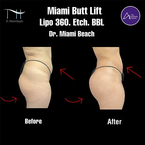 Miami Butt Lift Gallery at Dr. Miami Beach in Miami Beach, FL