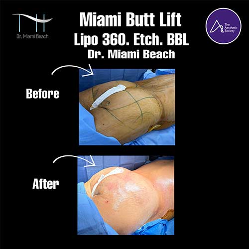 Miami Butt Lift Gallery at Dr. Miami Beach in Miami Beach, FL