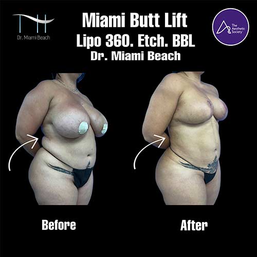 Miami Butt Lift Gallery at Dr. Miami Beach in Miami Beach, FL