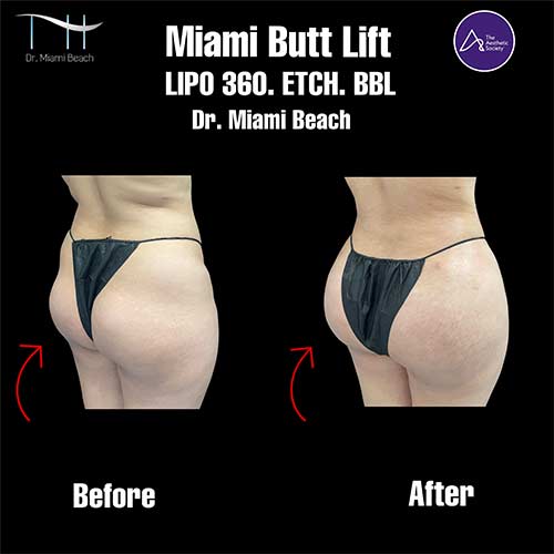 Miami Butt Lift Gallery at Dr. Miami Beach in Miami Beach, FL
