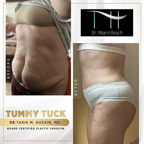 Tummy Tuck Gallery at Dr. Miami Beach in Miami Beach, FL