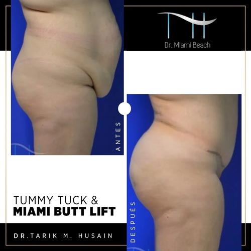Tummy Tuck Gallery at Dr. Miami Beach in Miami Beach, FL