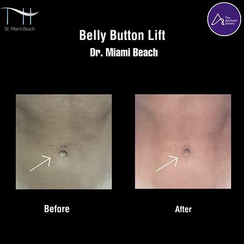 Tummy Tuck Gallery at Dr. Miami Beach in Miami Beach, FL