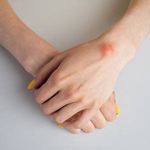 Gangloin Cyst Removal Surgery Near Me in Miami Beach, FL