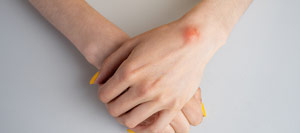 Ganglion Cyst Removal Surgery Specialist Near Me in Miami Beach, FL