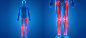 Limb Lengthening (Height Increase) Surgery Specialist Near Me in Miami Beach, FL
