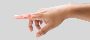 Trigger Finger Surgery Specialist Near Me in Miami Beach, FL