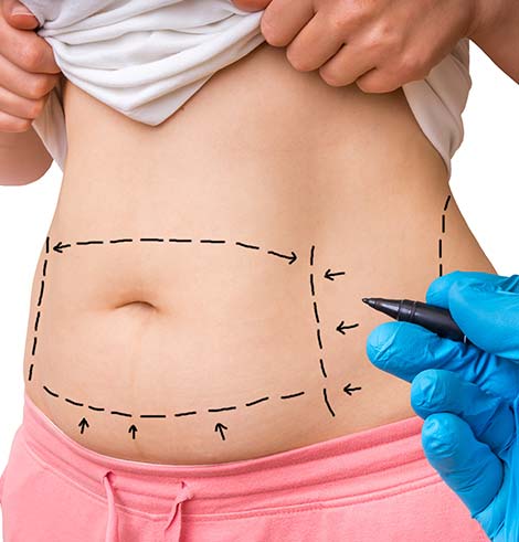 Tummy Tuck Gallery at Dr. Miami Beach in Miami Beach, FL