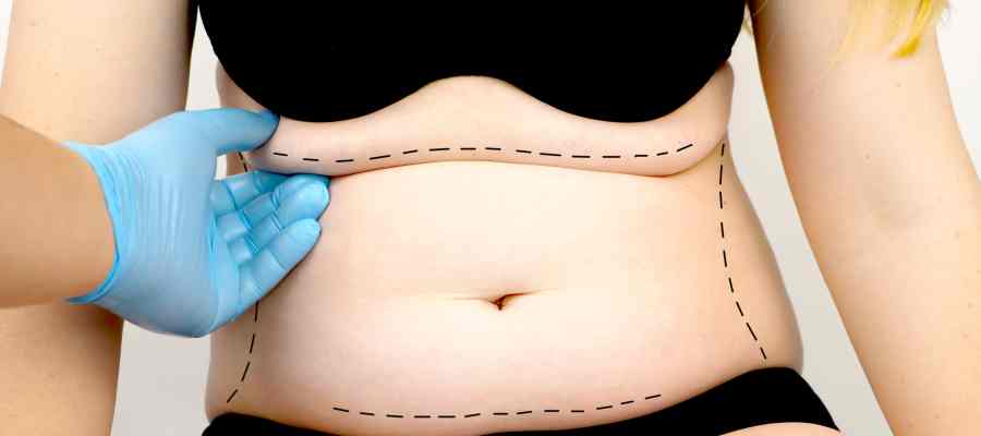 Tummy Tuck Surgery Specialist Near Me in Miami Beach, FL