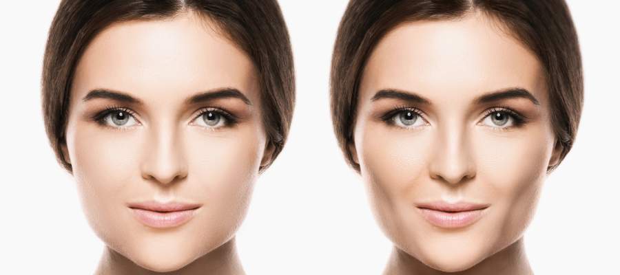 Buccal Fat Removal Surgery Specialist Near Me in Miami Beach, FL