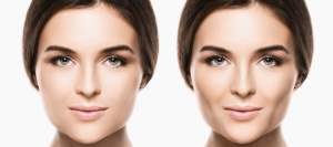 Buccal Fat Removal Surgery Specialist Near Me in Miami Beach, FL