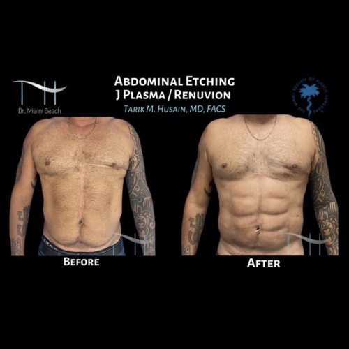 Abdominal Etching Male Gallery at Dr. Miami Beach in Miami Beach, FL