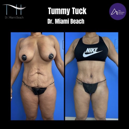 Tummy Tuck Gallery at Dr. Miami Beach in Miami Beach, FL