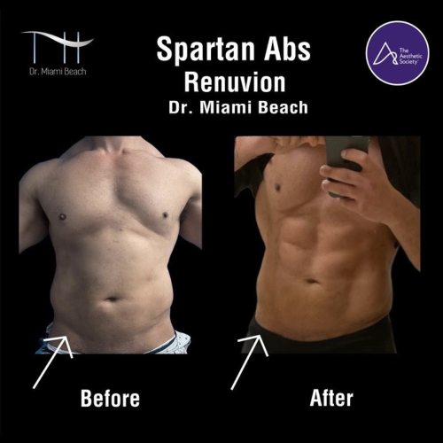 Abdominal Etching Male Gallery at Dr. Miami Beach in Miami Beach, FL