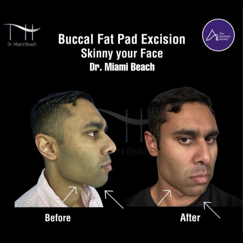 Buccal Fat Pad Excision at Dr. Miami Beach in Miami Beach, FL