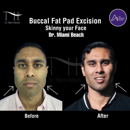 Buccal Fat Pad Excision at Dr. Miami Beach in Miami Beach, FL