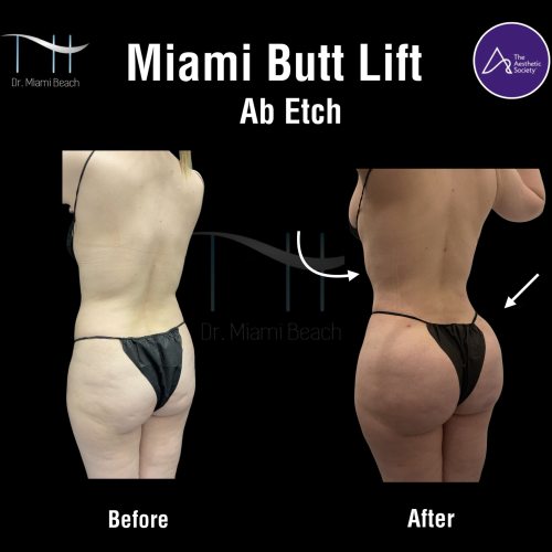 Miami Butt Lift Gallery at Dr. Miami Beach in Miami Beach, FL