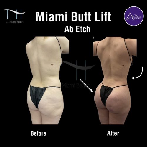 Miami Butt Lift Gallery at Dr. Miami Beach in Miami Beach, FL