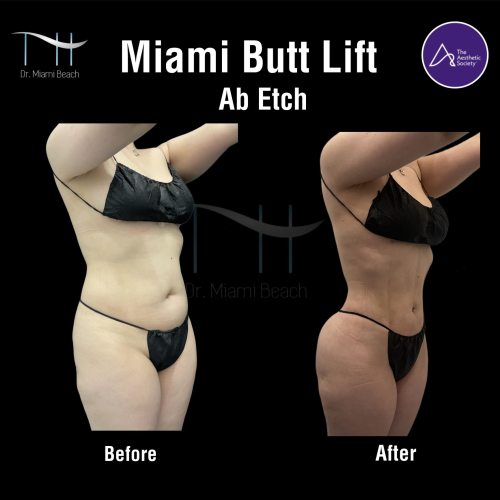 Miami Butt Lift Gallery at Dr. Miami Beach in Miami Beach, FL