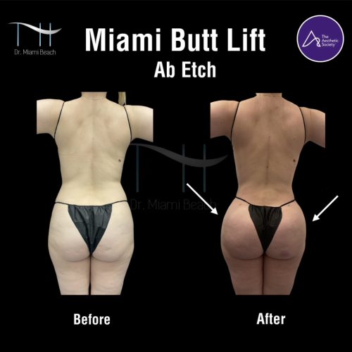 Miami Butt Lift Gallery at Dr. Miami Beach in Miami Beach, FL