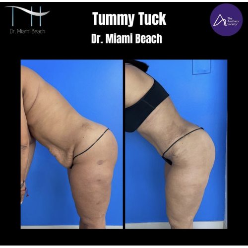 Tummy Tuck Gallery at Dr. Miami Beach in Miami Beach, FL