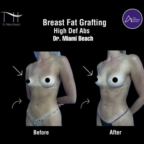 Breast Surgery Gallery at Dr. Miami Beach in Miami Beach, FL
