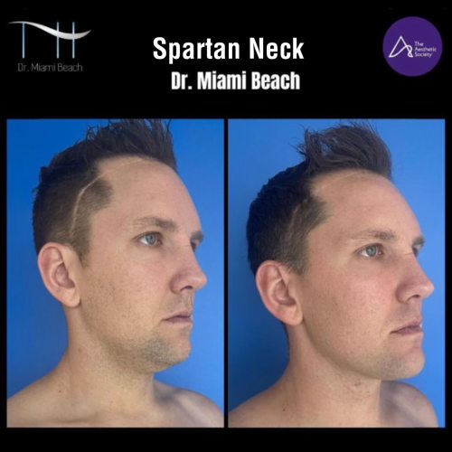 Spartan Neck at Dr. Miami Beach in Miami Beach, FL