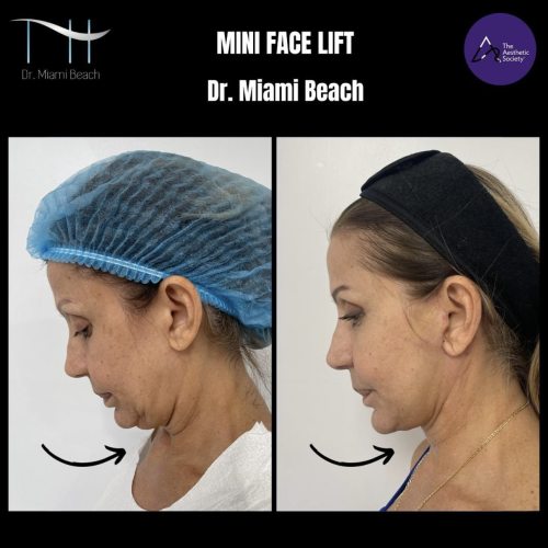 Mini Face Lift at Dr. Miami Beach in Miami Beach, FL