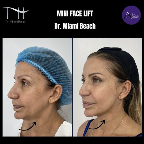 Mini Face Lift at Dr. Miami Beach in Miami Beach, FL