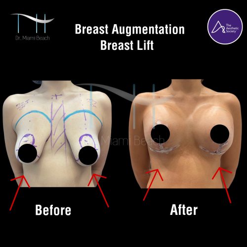 Breast Surgery Gallery at Dr. Miami Beach in Miami Beach, FL