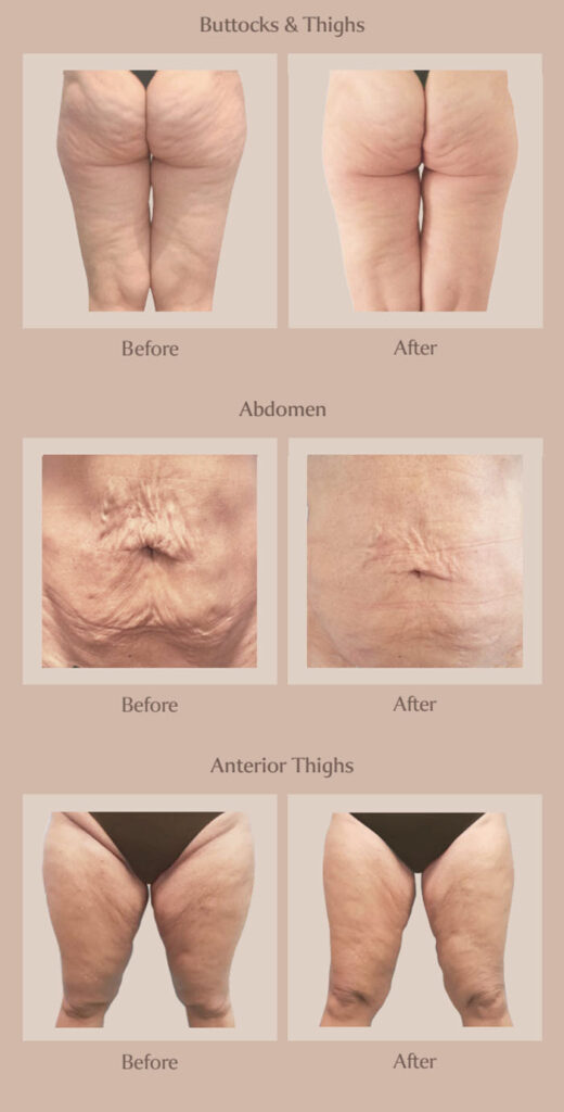 Before and After BodyESTIQ Near Me in Miami Beach, FL Before and After BodyESTIQ Near Me in Miami Beach, FL