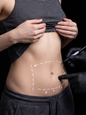Tummy Tuck at Dr. Miami Beach in Miami Beach, FL